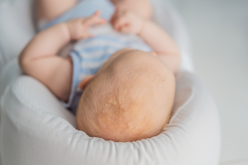 Understanding Cradle Cap