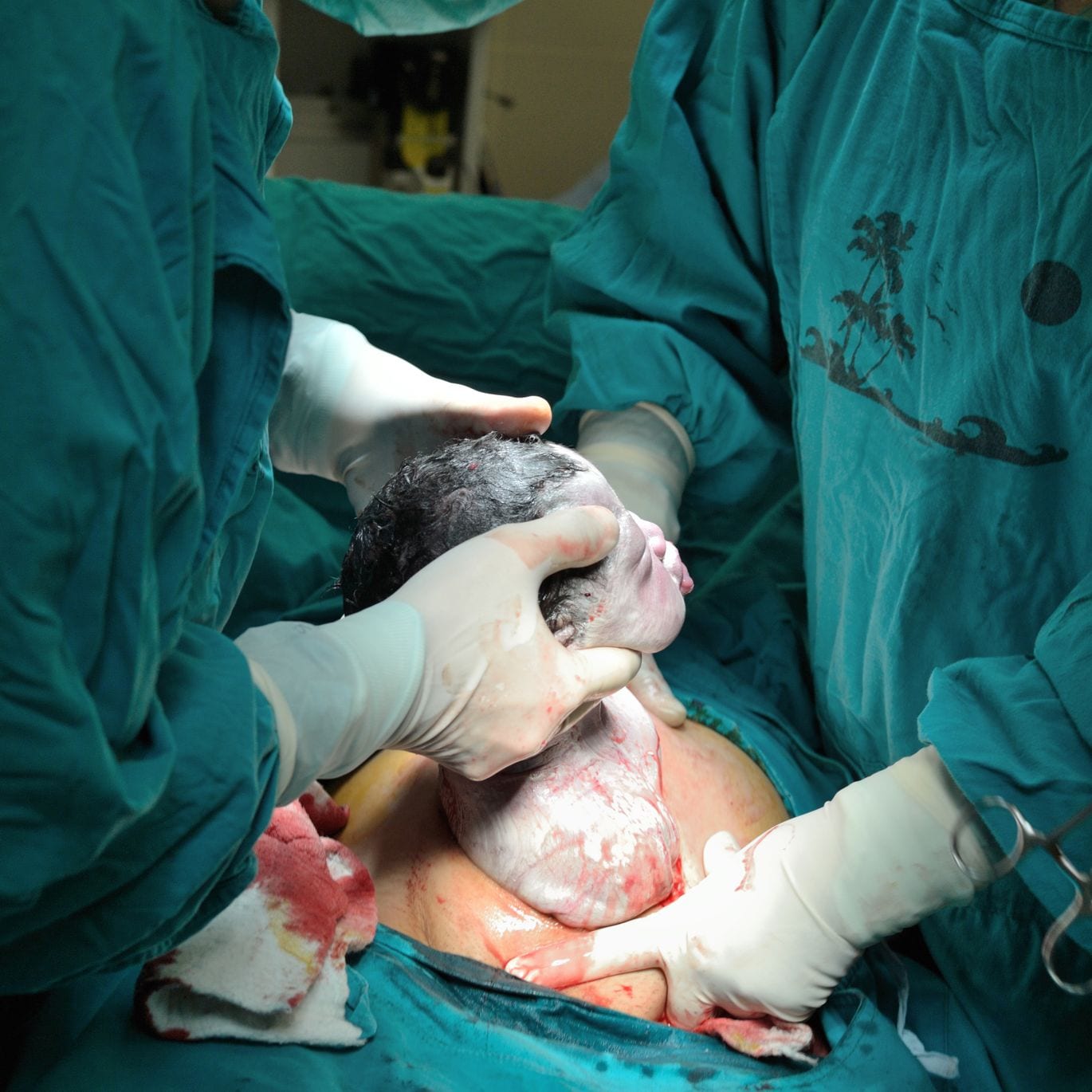 Vaginal Birth After Cesarean